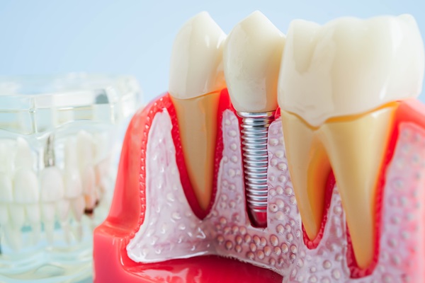 How Is A Dental Implant Placed?