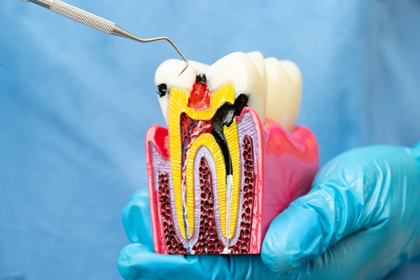 Root Canal Aftercare: Tips For A Smooth Recovery